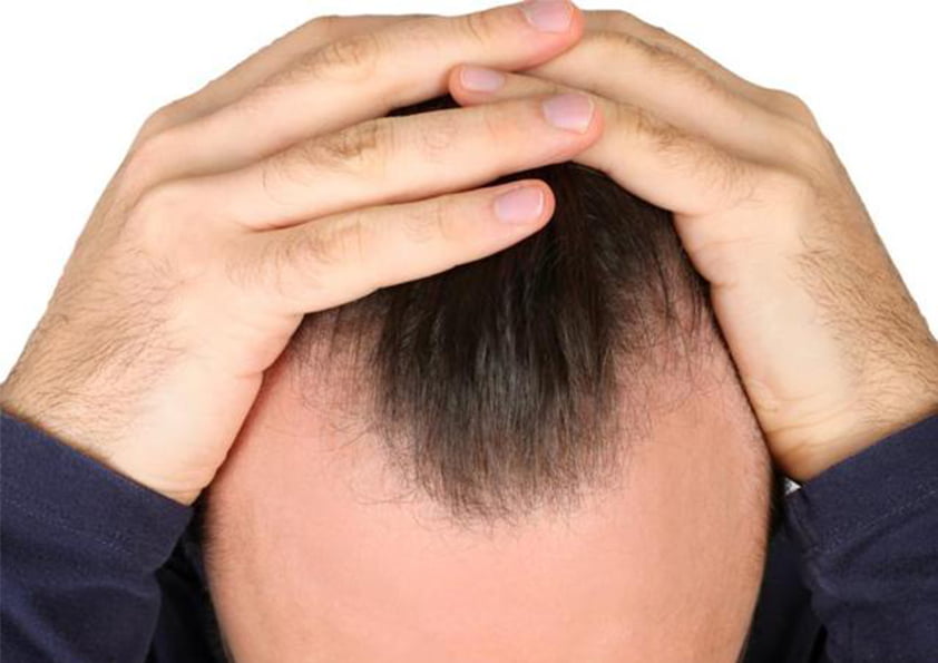 عمليات زراعة الشعر في تركيا بالليزر للرجال