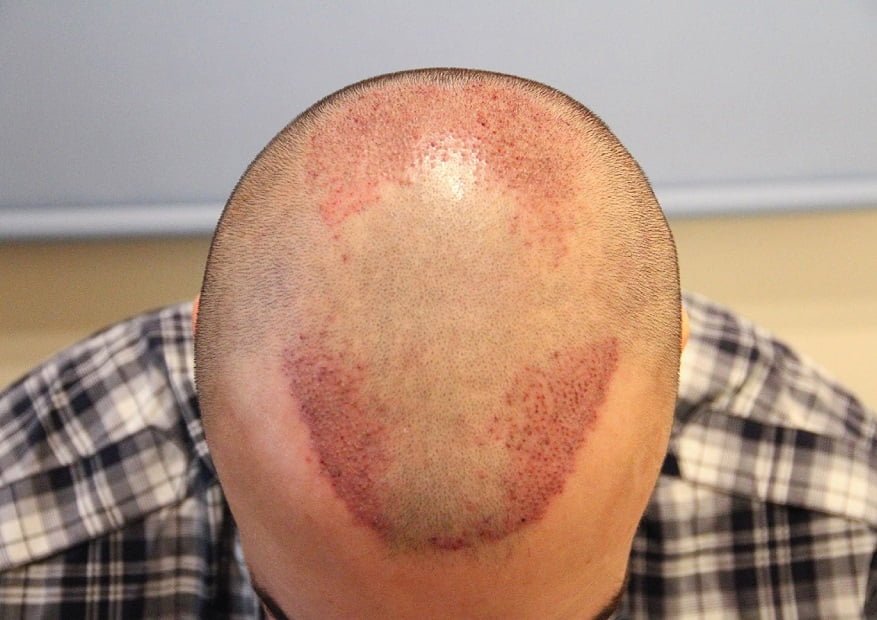 أفضل مراكز زراعة الشعر في تركيا