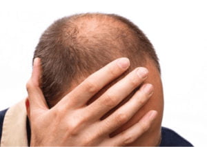 3 أخطاء يجب أن تتجنبهم عند زراعة الشعر في تركيا