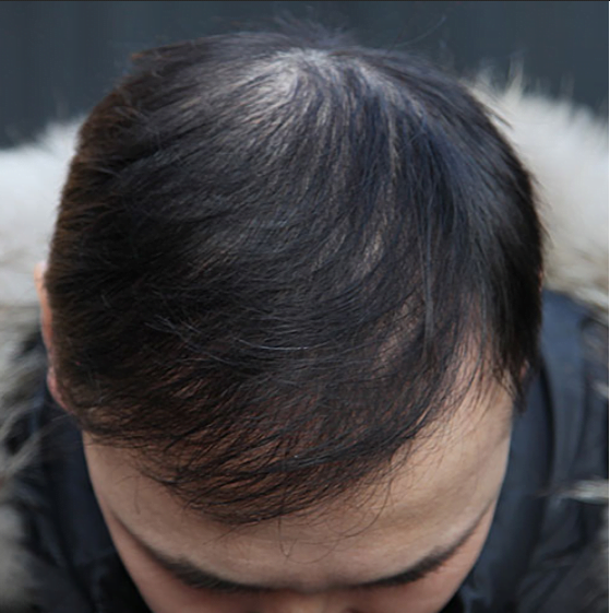 مراحل ظهور نتائج زراعة الشعر