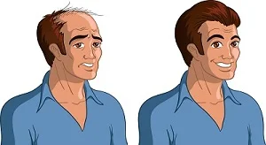 تكلفة زراعة الشعر في السعودية