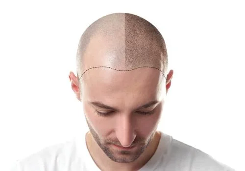 الشعر المزروع والمخاوف من تساقطه