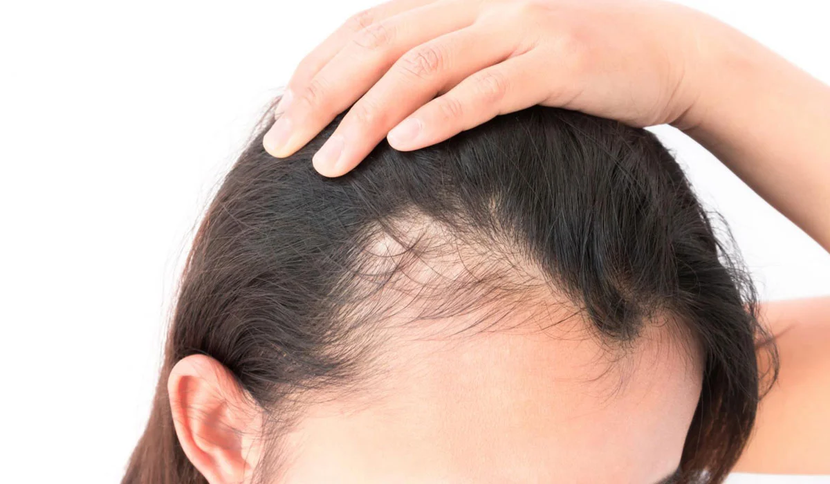 علاج تساقط الشعر للنساء