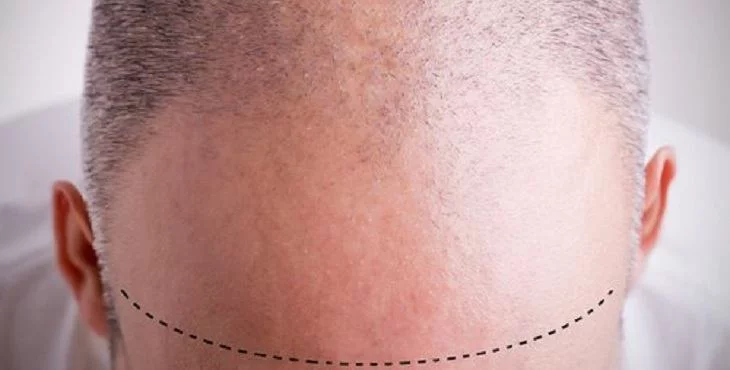 افضل دكتور زراعة الشعر في اسطنبول