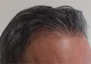 ف تختار أهم مراكز زراعة الشعر في تركيا؟