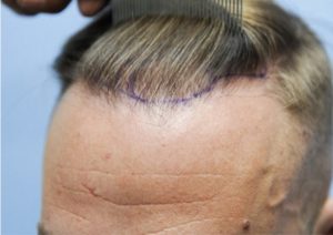 زراعة الشعر في تركيا بالليزر للرجال