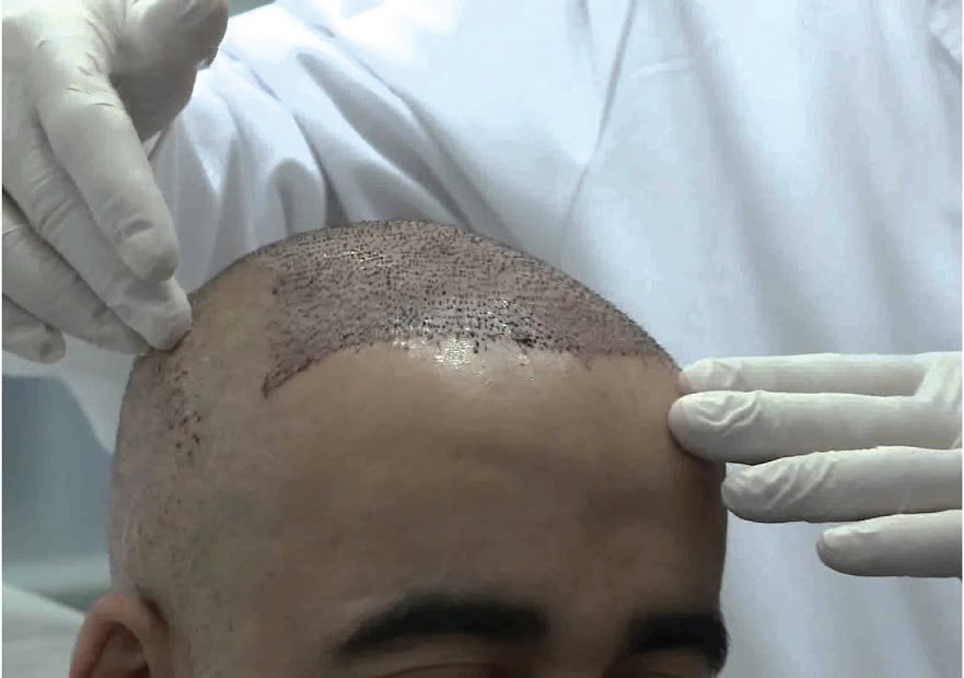 ماهو افضل مركز لزراعة الشعر في تركيا 