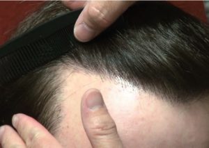 زراعة الشعر في تركيا للنساء