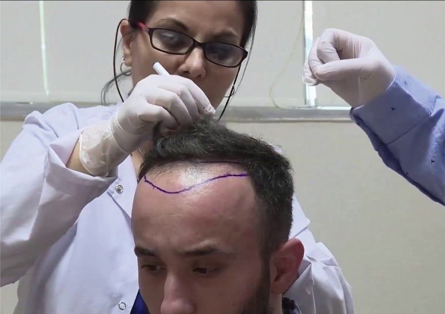 زراعة الشعر في تركيا 2022