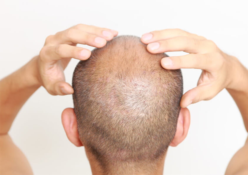 عمليات زراعة الشعر في تركيا بالليزر للرجال