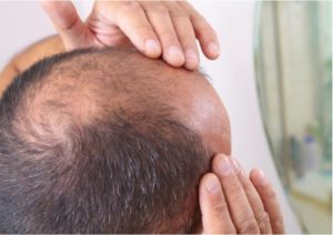 ف تختار أهم مراكز زراعة الشعر في تركيا؟