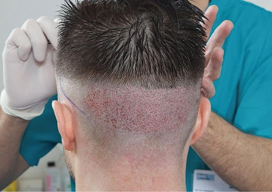 أفضل مراكز زراعة الشعر في تركيا 2019