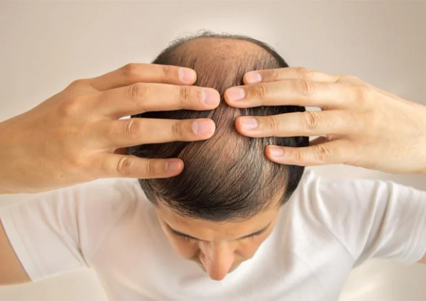 عمليات زراعة الشعر في تركيا بالليزر للنساء