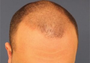 زراعة الشعر في تركيا للنساء