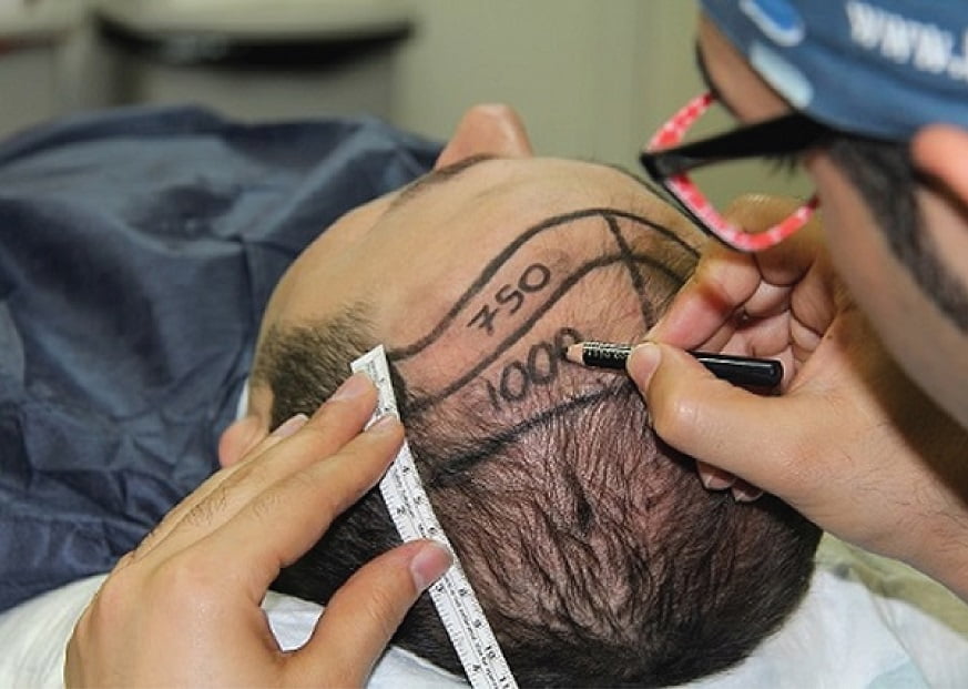 أفضل مراكز زراعة الشعر في تركيا