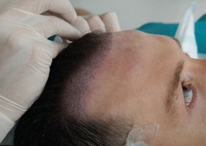 زراعة الشعر في تركيا للنساء