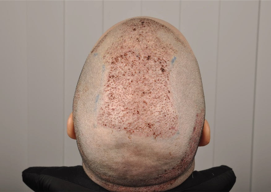 أفضل مراكز زراعة الشعر في تركيا 2019