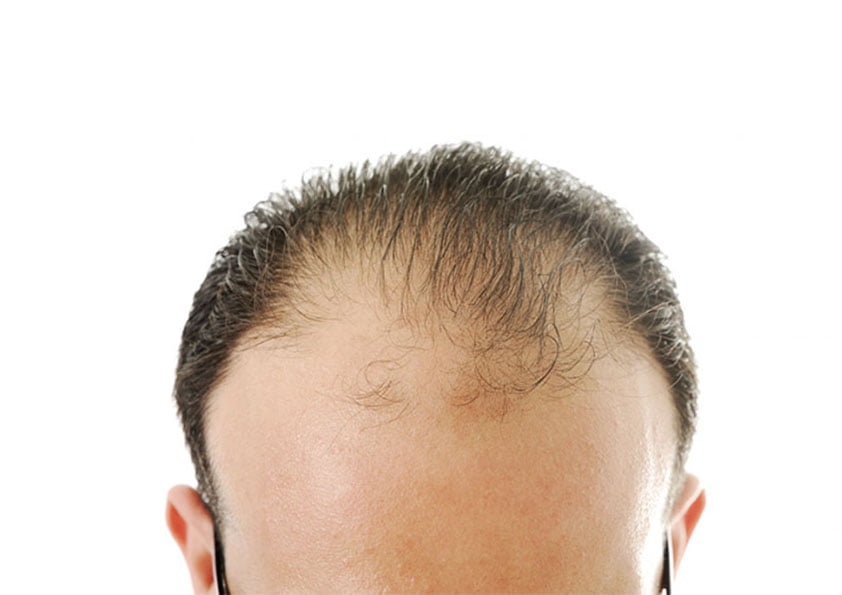 عمليات زراعة الشعر في تركيا بالليزر للنساء