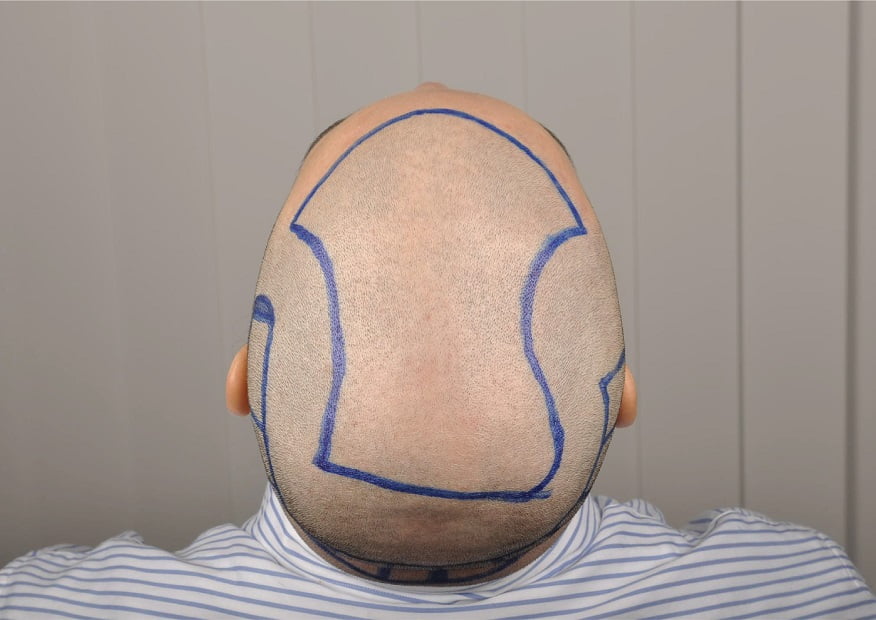 أفضل مراكز زراعة الشعر في تركيا