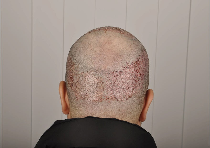 أفضل مراكز زراعة الشعر في تركيا