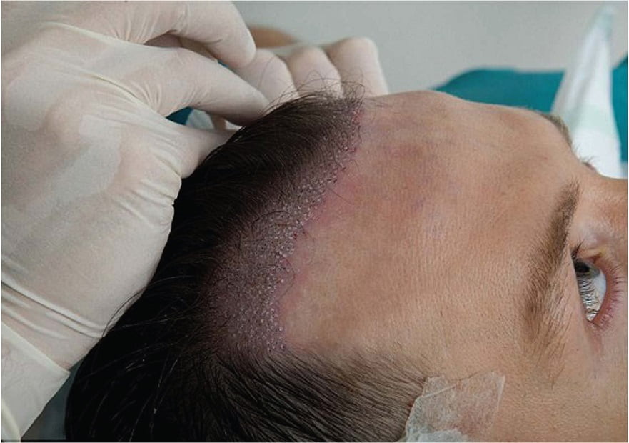 أفضل مراكز زراعة الشعر في تركيا 2019