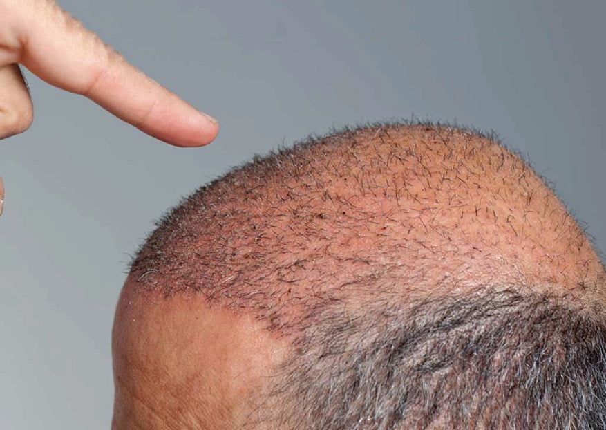 أفضل مراكز زراعة الشعر في تركيا