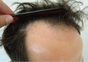 ف تختار أهم مراكز زراعة الشعر في تركيا؟