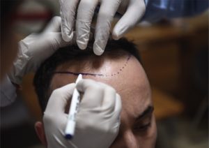 ف تختار أهم مراكز زراعة الشعر في تركيا؟