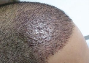 أفضل مراكز زراعة الشعر في تركيا