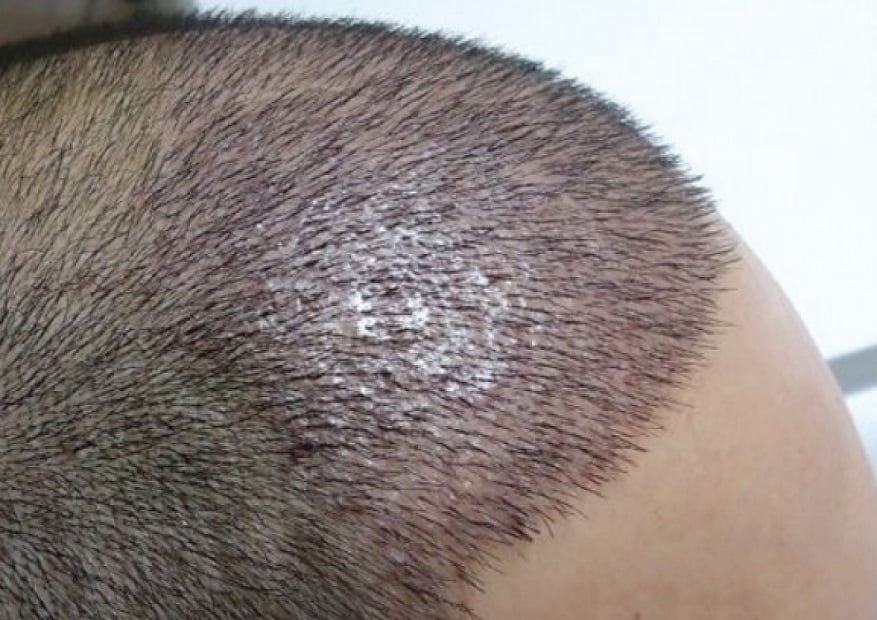 أفضل مراكز زراعة الشعر في تركيا 2019