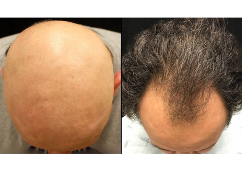 عمليات زراعة الشعر في تركيا بالليزر للرجال