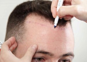 تكلفة زراعة الشعر في تركيا بالريال السعودي