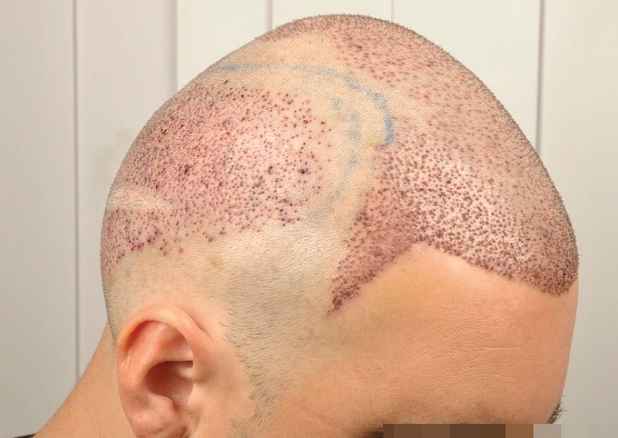 أفضل مراكز زراعة الشعر في تركيا